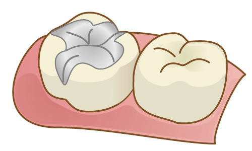 銀歯