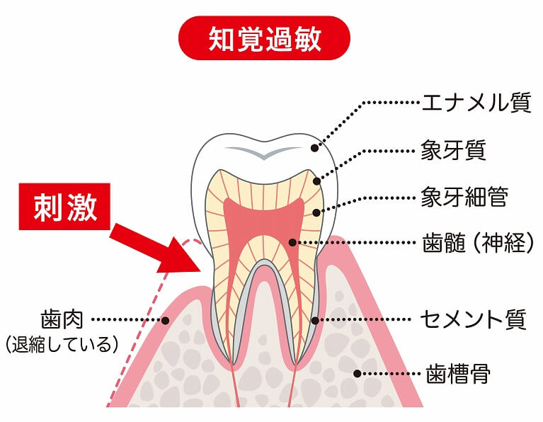 歯周病とは