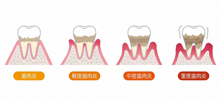 歯周病の分類