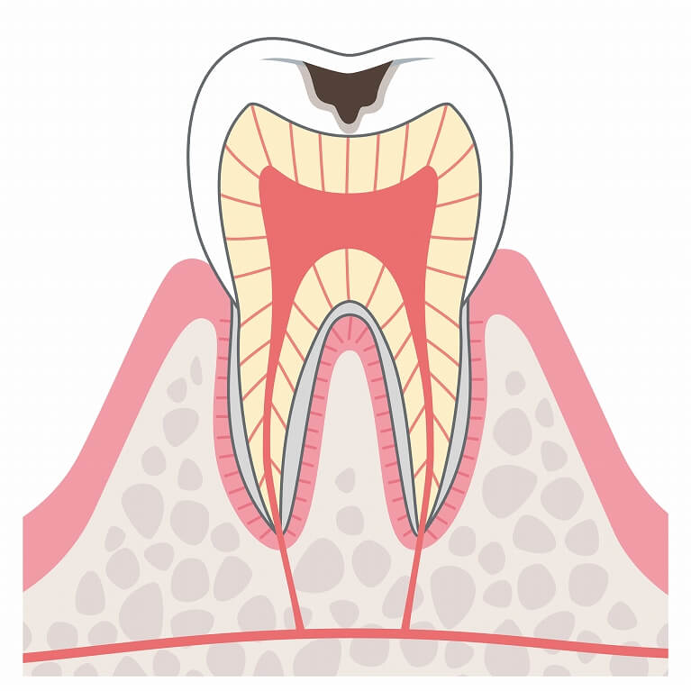 象牙質まで進行したむし歯