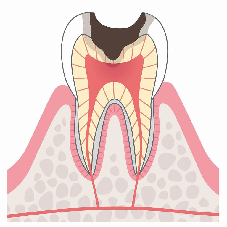 神経まで進行したむし歯