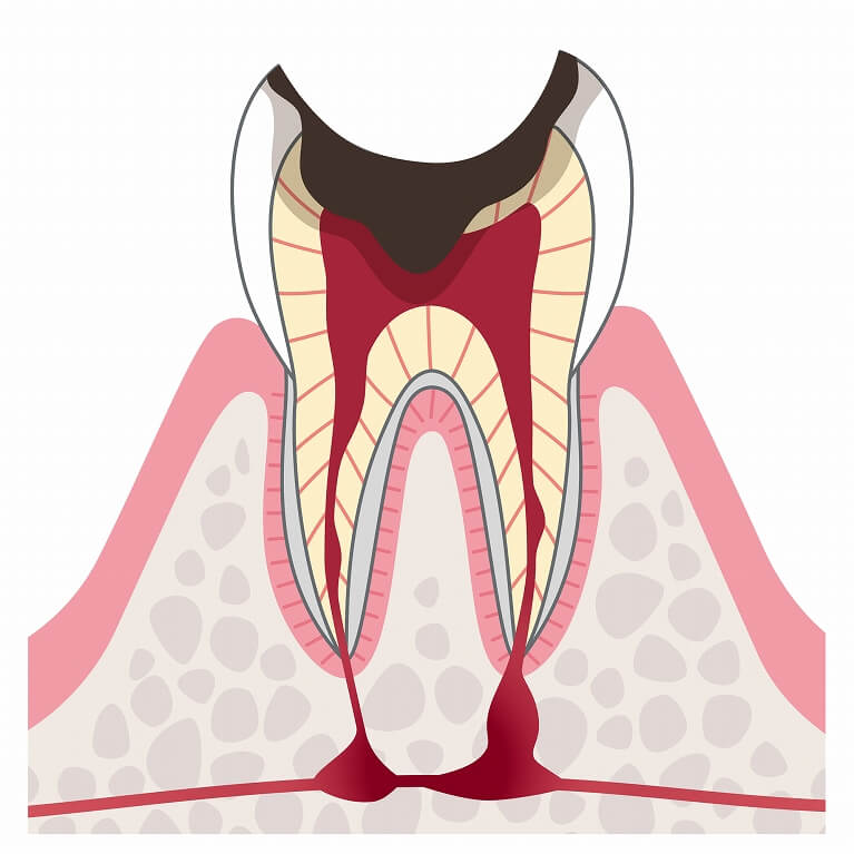 歯の根っこだけ残ったむし歯